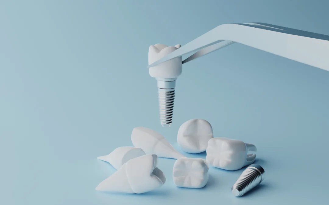 Everything You Need To Know About Dental Implants Malaysia