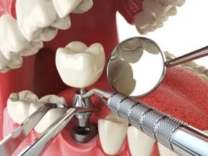 cost of dental implants Thailand procedure Burwood