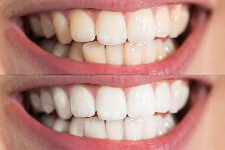 Good Choice Dental Teeth Whitening