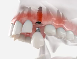 Pensioners Dental implants