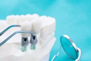 root canal therapy burwood