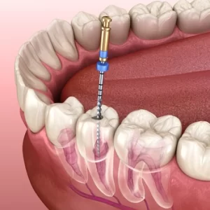 root canal treatment burwood