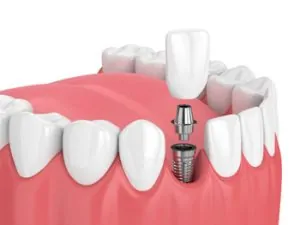 Sydney Dental Implants 